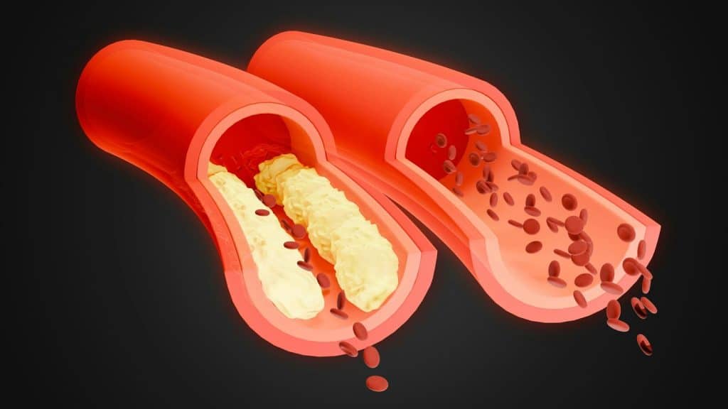 A digital image of comparison of having a blockage in vein and a healthy vein