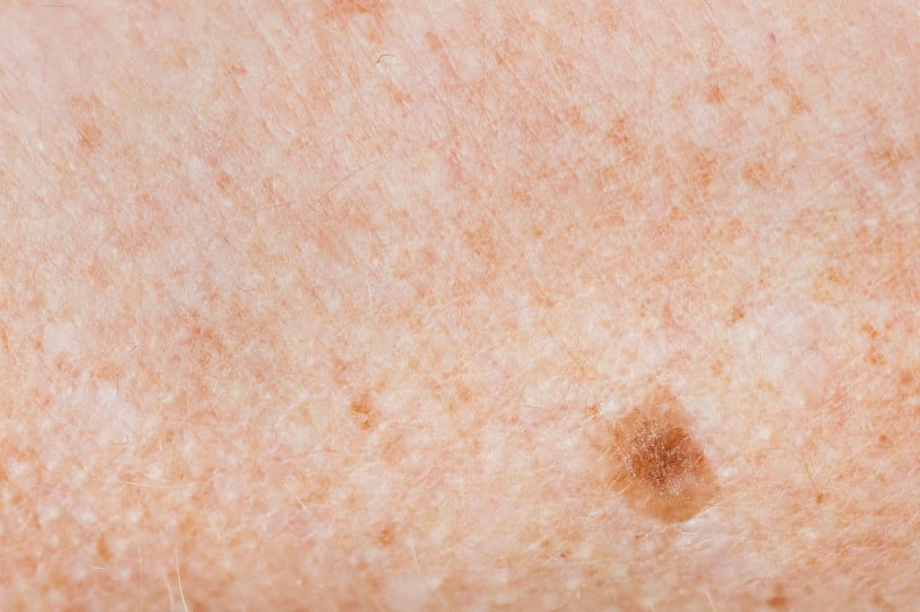 A close-up picture of a skin