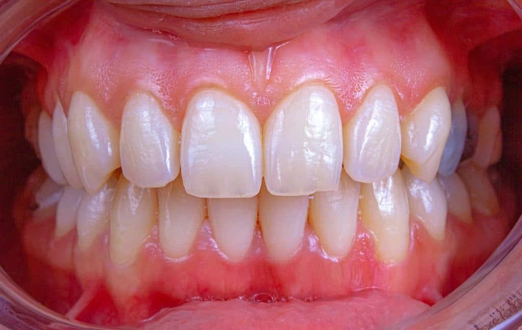 A picture of a human teeth and gums