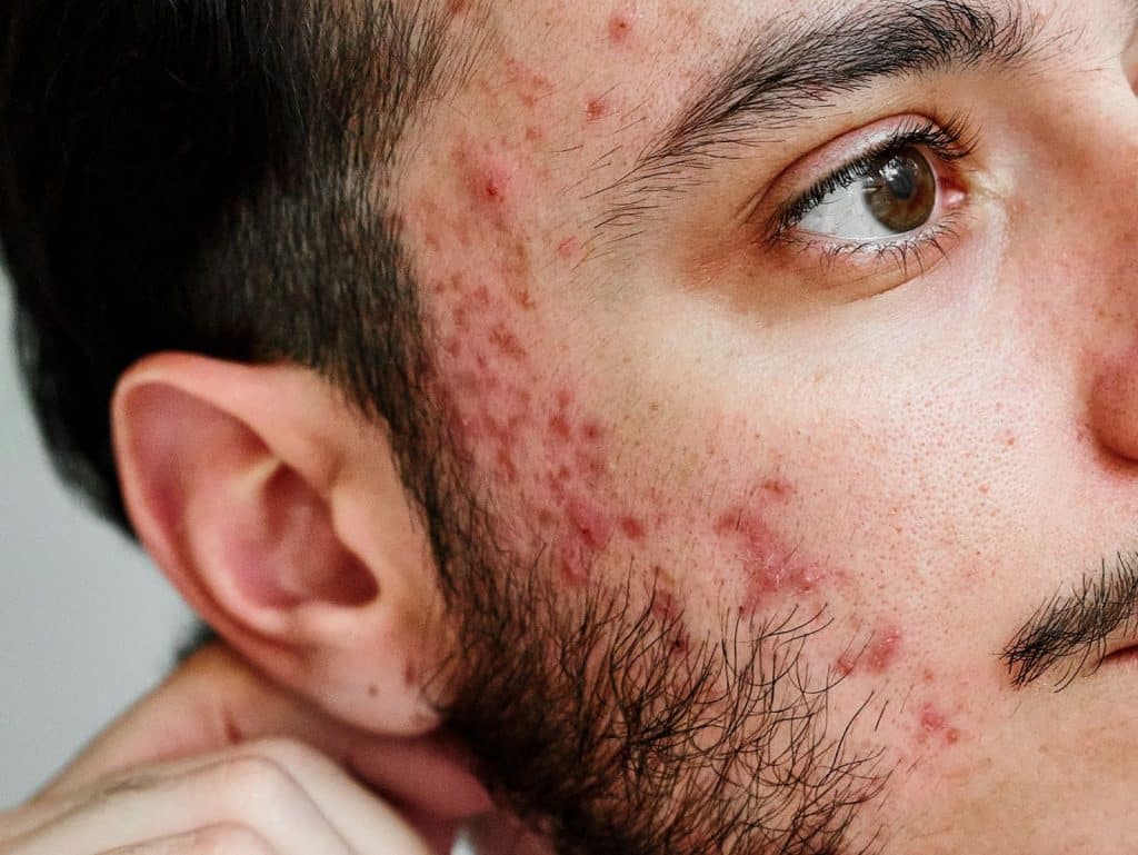 A man having an acne breakouts