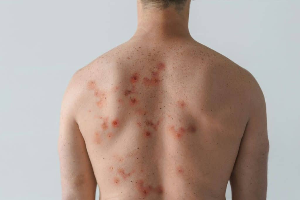 A picture of a man’s back with rashes