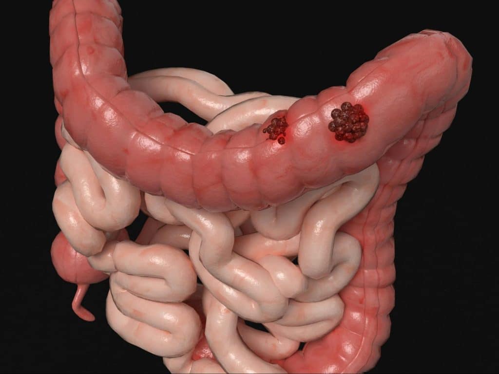 A picture of an illustrated colon with a damage