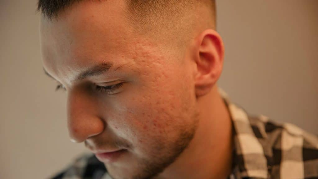 A close-up of a man with a fresh haircut and acne, looking down.