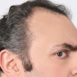 A man's profile shows a receding hairline and an angry expression.