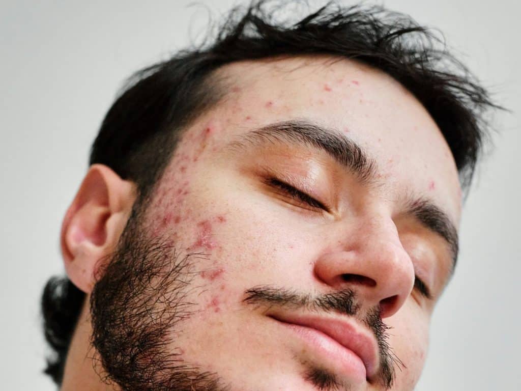 A man with an acne on his face