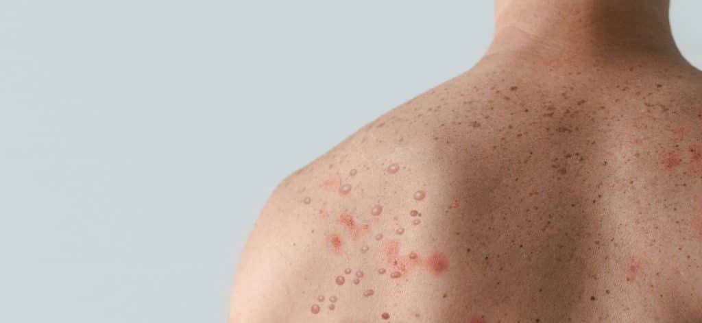 A close-up picture of a man’s with acne